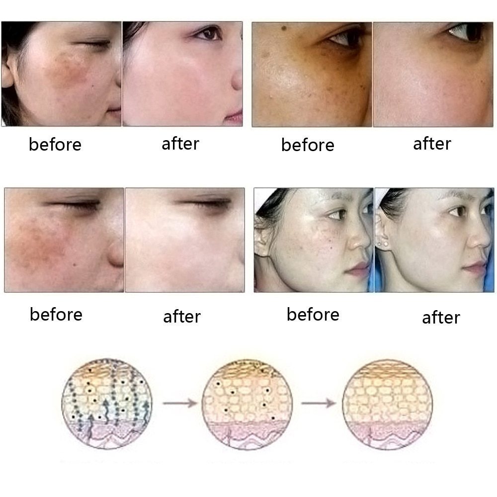 Natural Acne, Scar & Stretch Mark Removal Essence Oil – Herbal Skin Brightening & Regeneration Formula (10ml)