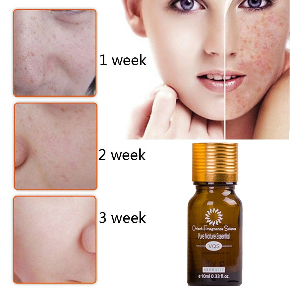 Natural Acne, Scar & Stretch Mark Removal Essence Oil – Herbal Skin Brightening & Regeneration Formula (10ml)